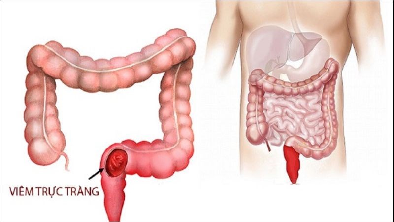 Rò hậu môn nhiều lần có thể gây viêm đại tràng