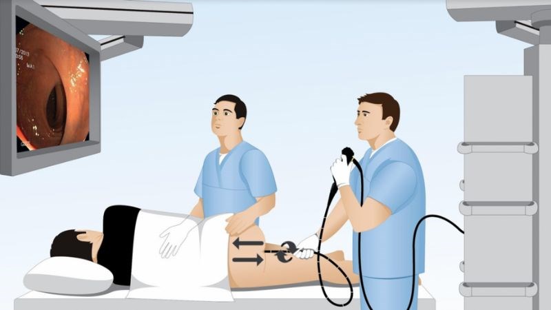 Nội soi hậu môn trực tràng giúp tìm được chính xác vị trí lỗ rò