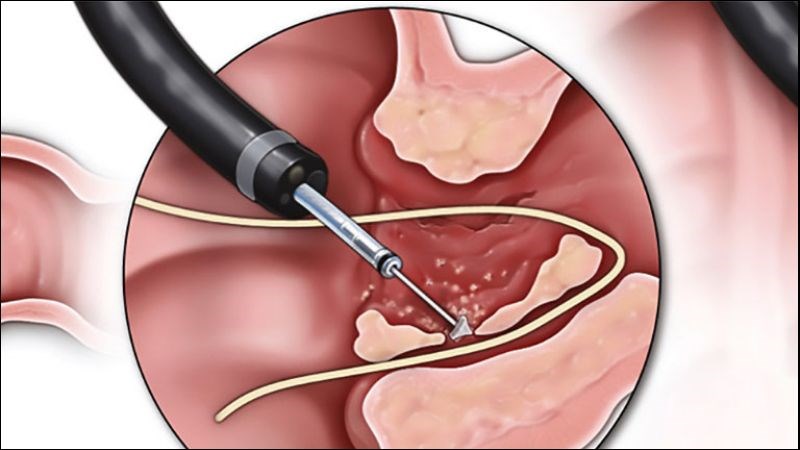 Phẫu thuật là phương pháp tốt nhất để điều trị lỗ rò