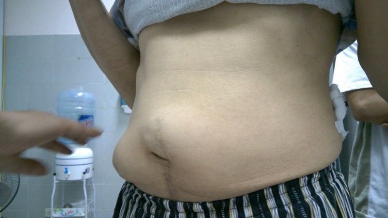 Có thể xuất hiện một khối lồi ra ngoài ổ bụng