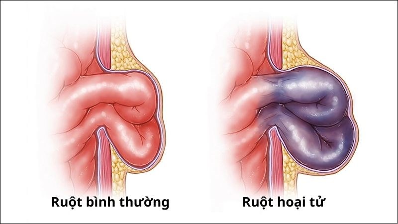 Thoát vị thành bụng có thể gây hoại tử ruột