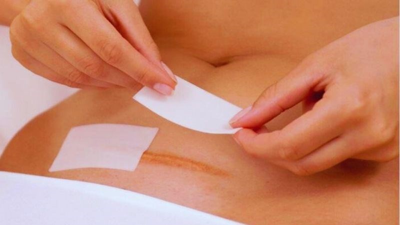 Vệ sinh vết mổ sạch sẽ tránh nhiễm khuẩn