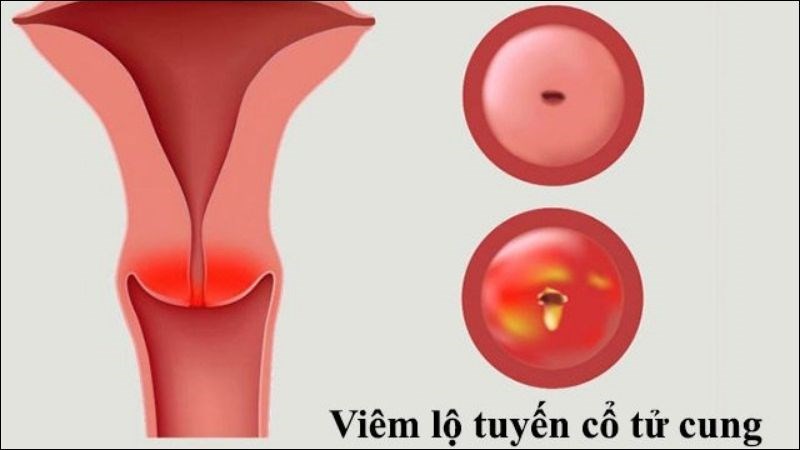 Viêm lộ tuyến cổ tử cung là yếu tố gây nên hình thành nang