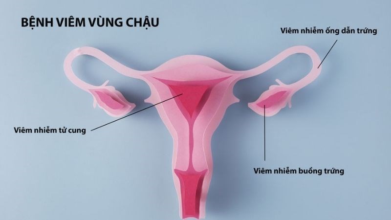 Bệnh có thể làm nhiễm trùng ngược dòng gây viêm vùng chậu