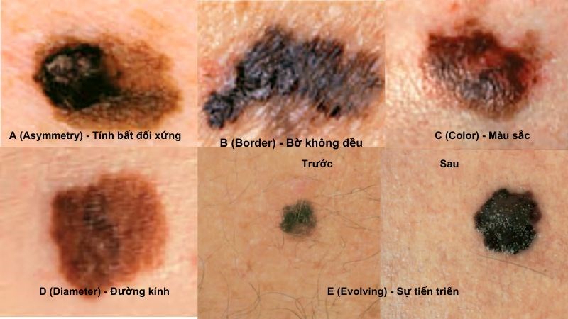 Nốt ruồi ung thư ác tính có hình dạng khác nhau
