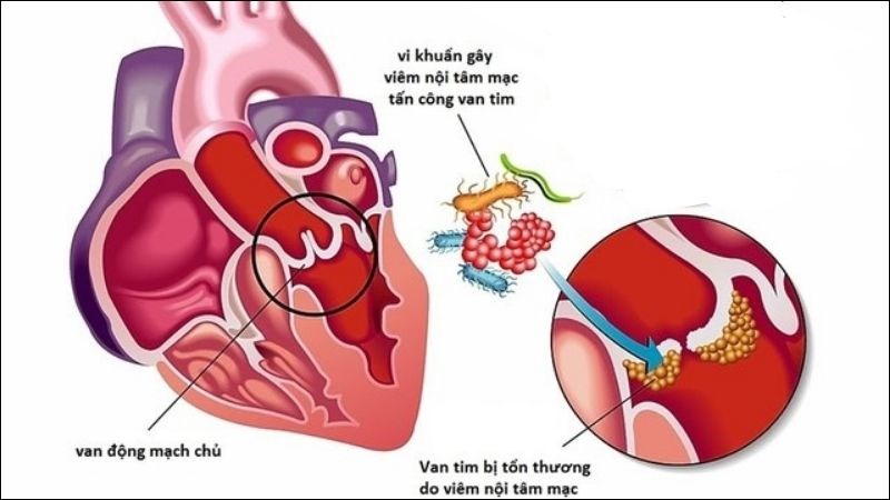 Viêm nội tâm mạc là tình trạng vi khuẩn tấn công vào van tim