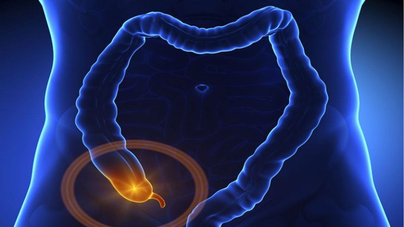 Viêm ruột thừa nếu không điều trị thích hợp có thể gây viêm phúc mạc
