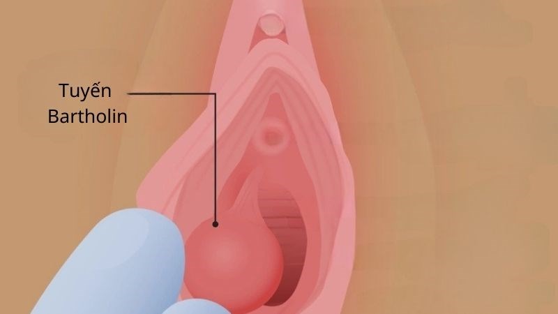 Viêm tuyến Bartholin hình thành do tắc nghẽn dịch tiết vùng âm đạo