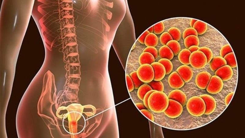 Lậu là một trong những nguyên nhân gây viêm tuyến Bartholin
