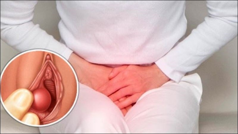 Người bệnh có thể thấy đau, kích thích, khó chịu khi đi lại, ngồi hoặc quan hệ tình dục