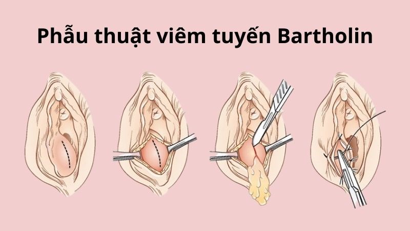 Viêm tuyến Bartholin: Nguyên nhân, triệu chứng và cách điều trị