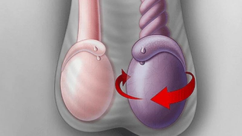 Sưng bìu tinh hoàn là tình trạng bìu bị sưng to Sưng bìu tinh hoàn là tình trạng bìu bị sưng to