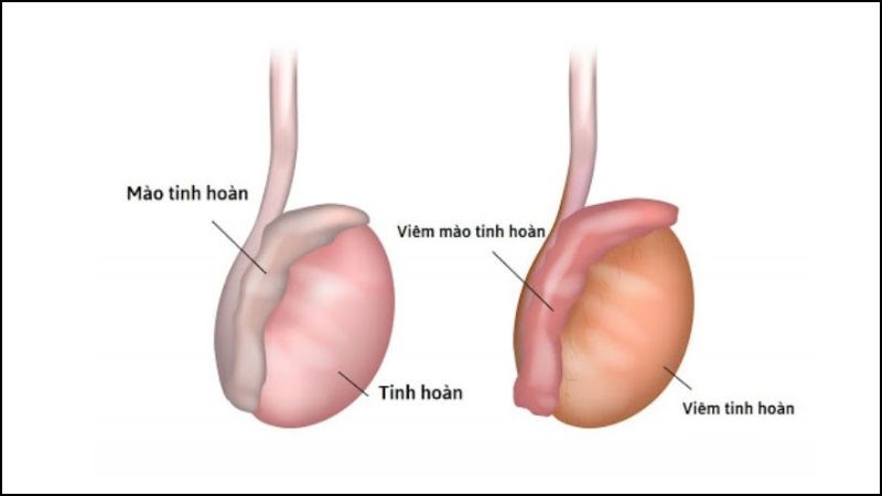 Viêm mào tinh hoàn là tình trạng sưng và kích ứng của mào tinh hoàn Viêm mào tinh hoàn là tình trạng sưng và kích ứng của mào tinh hoàn