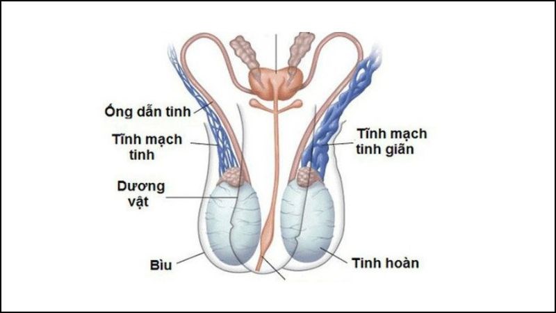 Giãn tĩnh mạch thừng tinh có thể dẫn đến sưng bìu tinh hoàn
