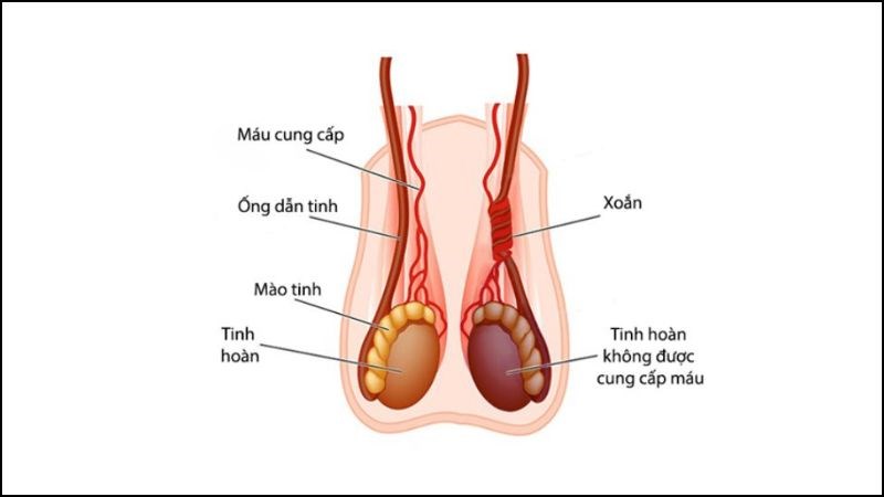 Thừng tinh bị xoắn lại trong bìu, làm gián đoạn lưu lượng máu đến tinh hoàn Thừng tinh bị xoắn lại trong bìu, làm gián đoạn lưu lượng máu đến tinh hoàn