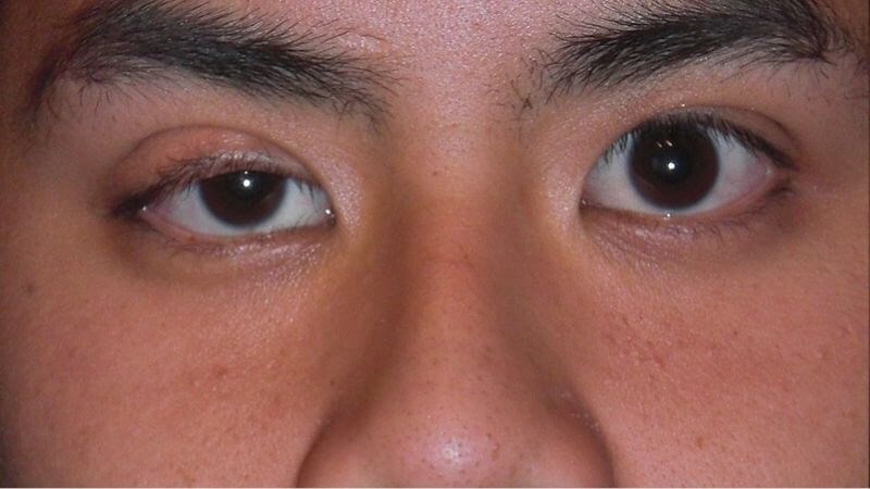 Song thị có thể gây sụp mí mắt Song thị có thể gây sụp mí mắt