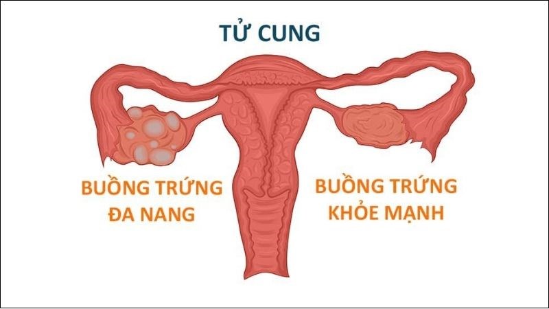 Hội chứng đa ngang buồng trứng cũng có thể là nguyên nhân của trình trạng cáu gắt