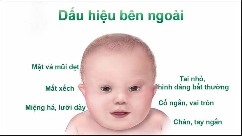 Hội chứng Down ảnh hưởng đến quá trình mọc răng Hội chứng Down ảnh hưởng đến quá trình mọc răng