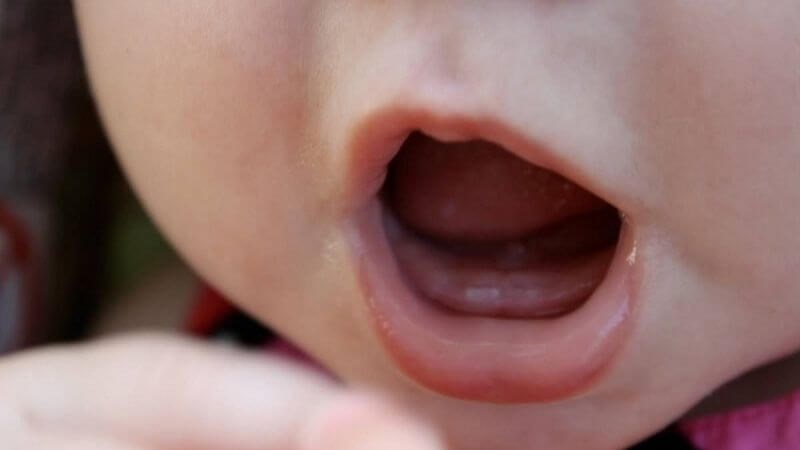 Chậm mọc răng là tình trạng răng sữa mọc chậm ở trẻ nhỏ Chậm mọc răng là tình trạng răng sữa mọc chậm ở trẻ nhỏ