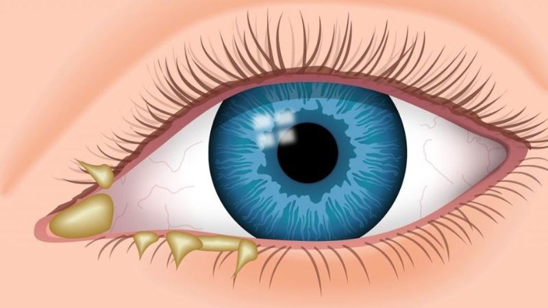 Khi co giật mắt kèm chảy nhiều dịch nên đến các cơ sở y tế