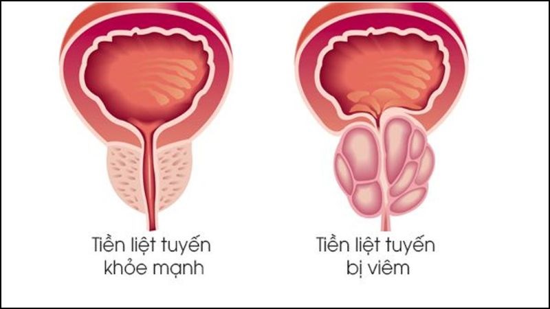 Viêm tuyến tiền liệt là một nguyên nhân phổ biến gây đau khi xuất tinh Viêm tuyến tiền liệt là một nguyên nhân phổ biến gây đau khi xuất tinh