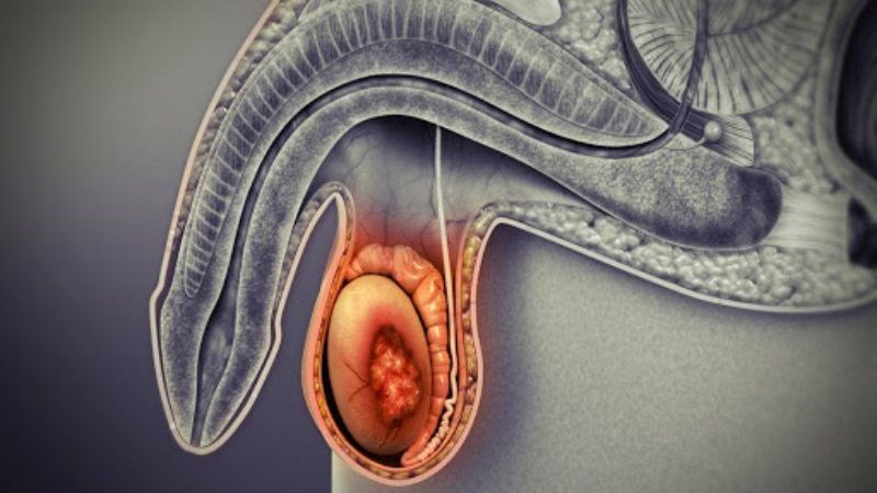 Viêm tinh hoàn có thể gây đau khi xuất tinh Viêm tinh hoàn có thể gây đau khi xuất tinh