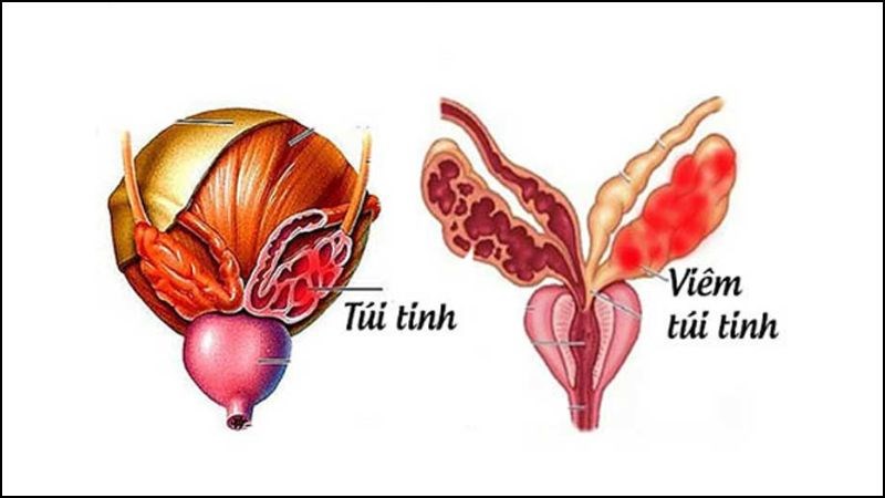 Viêm túi tinh có thể gây đau khi xuất tinh Viêm túi tinh có thể gây đau khi xuất tinh
