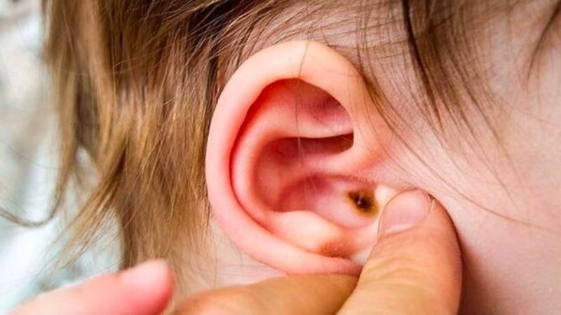 Tích tụ ráy tai lâu ngày tạo điều kiện cho vi khuẩn gây bệnh dẫn đến đau tai