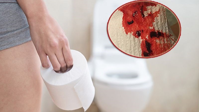 Triệu chứng bao gồm đau khi tiểu tiện, xuất hiện máu tươi trong bồn cầu sau khi đại tiện
