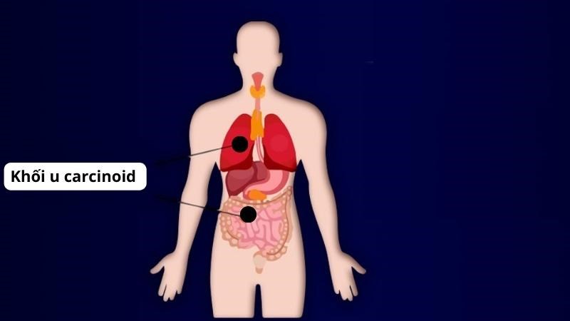 Khối u carcinoid thường xuất hiện ở đường tiêu hóa và phổi