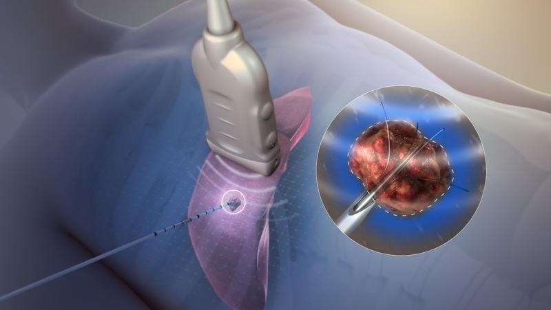 Sóng radio có thể được sử dụng để điều trị các khối u di căn nhỏ