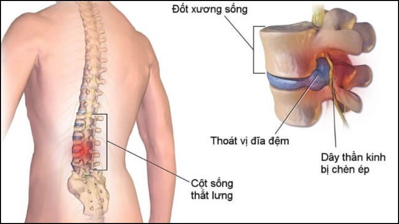 Thoát vị đĩa đệm ở thắt lưng có thể gây ra hội chứng chùm đuôi ngựa Thoát vị đĩa đệm ở thắt lưng có thể gây ra hội chứng chùm đuôi ngựa