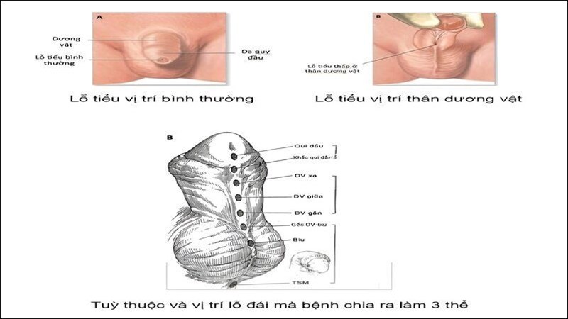Lỗ tiểu lệch thấp là tình trạng lỗ tiểu nằm vị trí thấp hơn so với bình thường