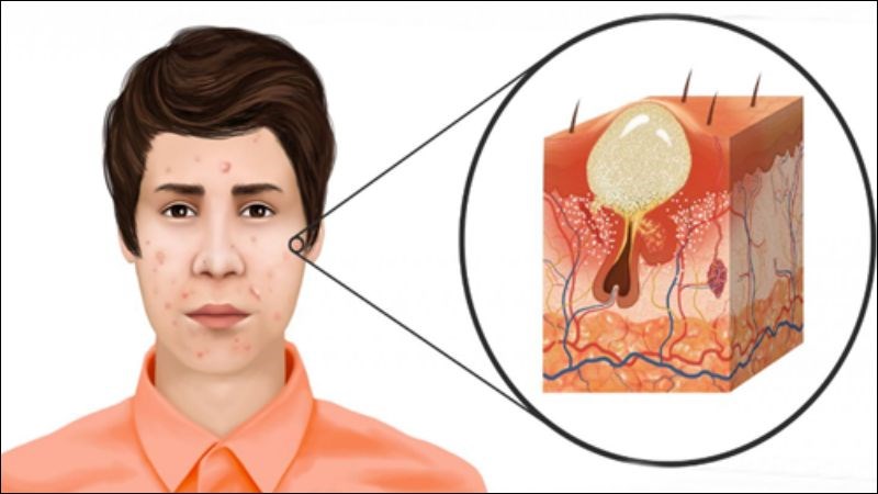 Mụn hình thành do lỗ chân lông bị bít tắc