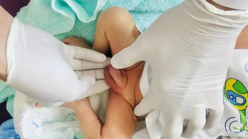 Bìu quá rộng có thể là nguyên nhân gây sa tinh hoàn ở trẻ em