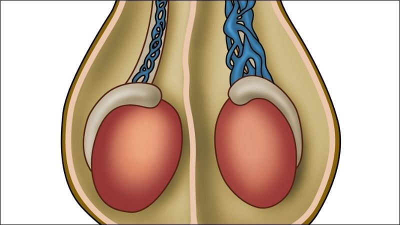 Giãn tĩnh mạch thừng tinh là một trong những bệnh lý gây rối loạn sản xuất tinh trùng