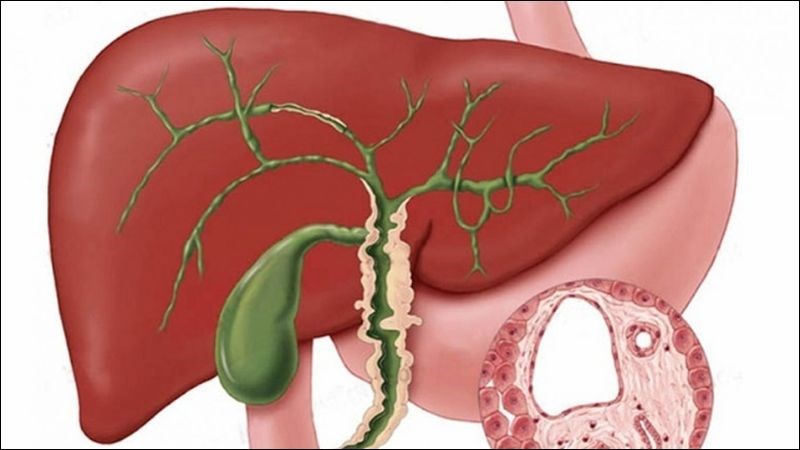 Viêm đường mật nguyên phát có thể dẫn tới suy gan