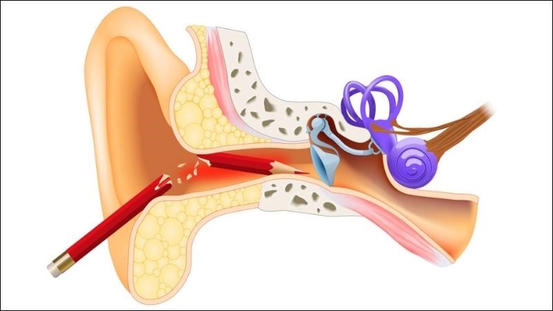 Dị vật tai có thể đâm thủng màng nhĩ bất kỳ lúc nào Dị vật tai có thể đâm thủng màng nhĩ bất kỳ lúc nào