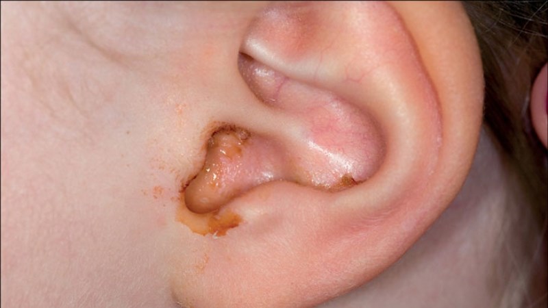 Triệu chứng nhiễm trùng sẽ giảm khi mủ chảy ra ngoài