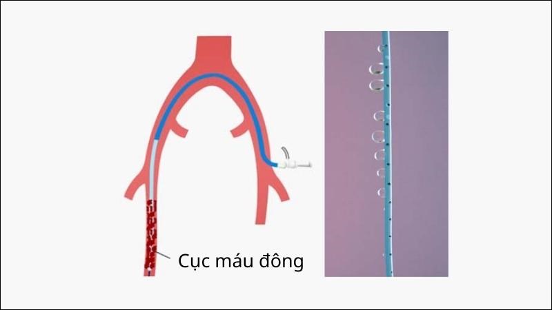 Ống thông cục máu đông để điều trị thuyên tắc phổi