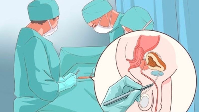 Phẫu thuật giúp cải thiện một số bệnh lý gây cản trở đường đi của tinh trùng