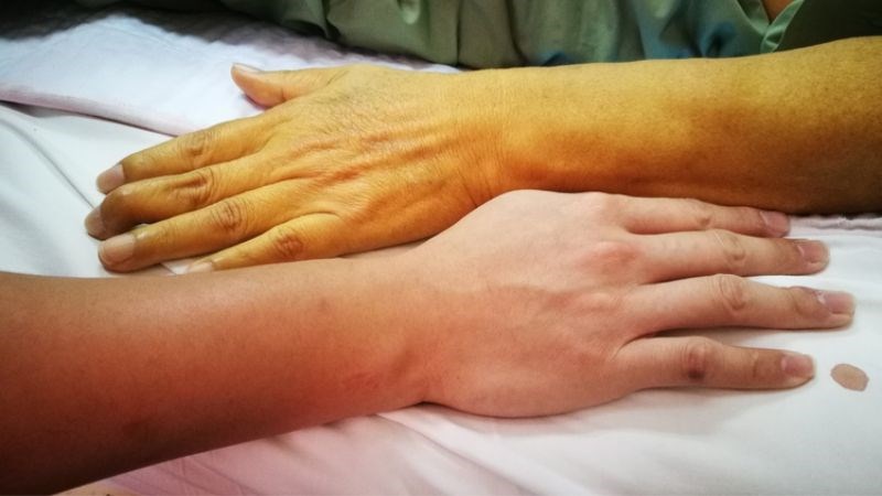 Hội chứng vàng da là do sự tích tụ của bilirubin trong cơ thể