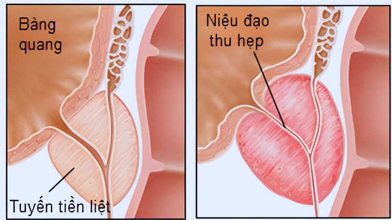 Khi tuyến tiền liệt bị nhiễm trùng  tinh dịch có thể đổi màu