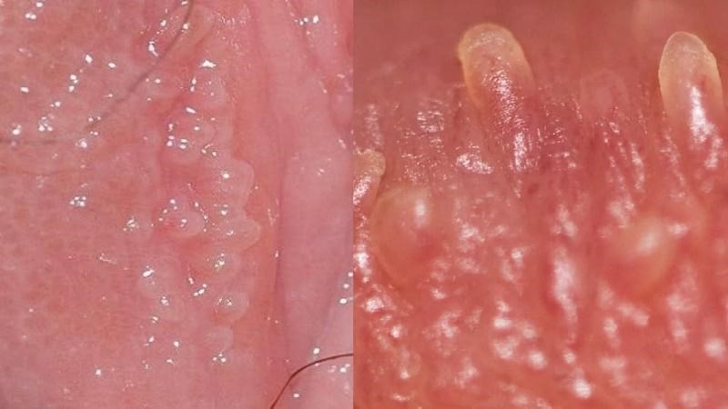 U nhú sinh dục là các mụn thịt lành tính