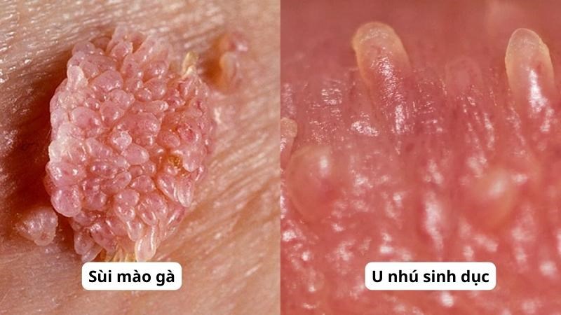 Triệu Chứng Nhận Biết