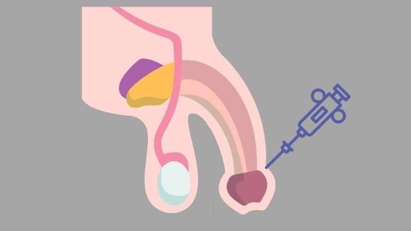 Sinh thiết có thể được thực hiện khi nghi ngờ u nhú ác tính