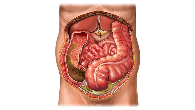 Viêm phúc mạc là biến chứng nguy hiểm của viêm ruột thừa