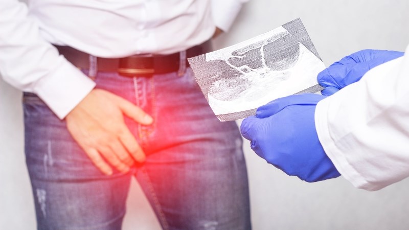 Viêm mào tinh có thể dẫn đến tắc mào tinh và cản trở đường đi của tinh trùng khi xuất tinh Viêm mào tinh có thể dẫn đến tắc mào tinh và cản trở đường đi của tinh trùng khi xuất tinh