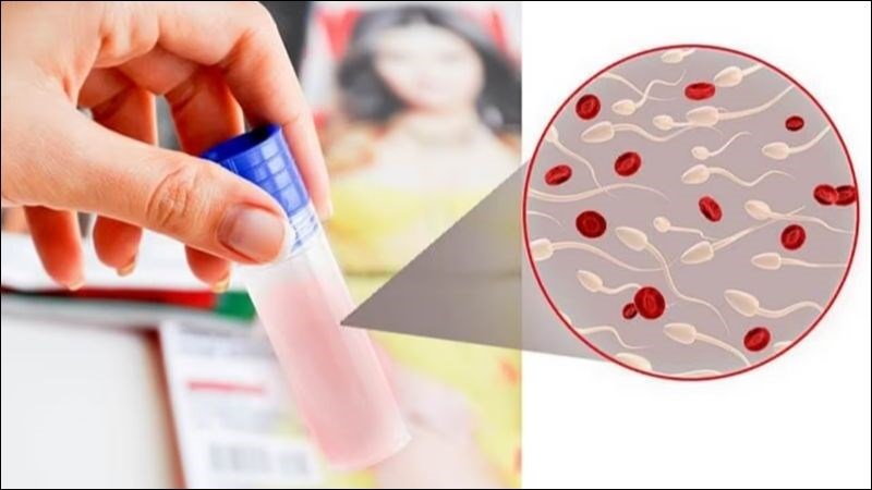 Xét nghiệm máu để đánh giá tình trạng xuất tinh ra máu.