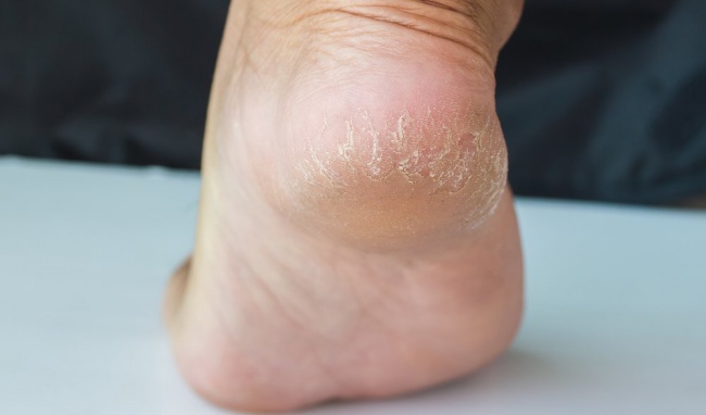 Causes of Cracked Heels